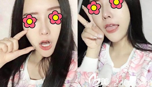 肋軟骨隆鼻手術(shù)60天恢復(fù)<span style=