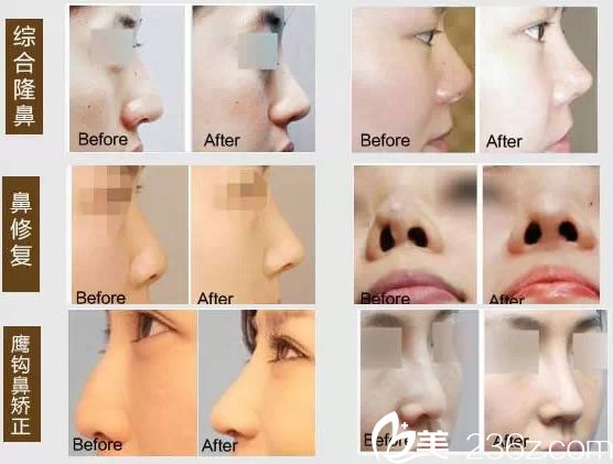 <!--<i data=20240703-sp></i>-->整形隆鼻及修復(fù)案例