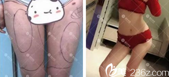 張梅醫(yī)師大腿吸脂案例