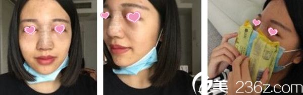 謝靚花隆鼻手術(shù)案例 謝靚花隆鼻手術(shù)案例