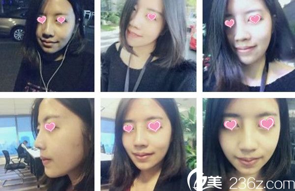 假體隆鼻后恢復(fù)效果 假體隆鼻后恢復(fù)效果