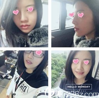 假體隆鼻后一個(gè)月恢復(fù)效果 假體隆鼻后一個(gè)月恢復(fù)效果