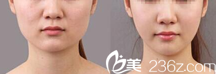 北京米蘭柏羽麗都<!--<i data=20240703-sp></i>-->注射瘦臉案例 北京米蘭柏羽麗都<!--<i data=20240703-sp></i>-->注射瘦臉案例