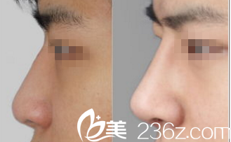 北京米蘭柏羽麗都<!--<i data=20240703-sp></i>-->注射隆鼻案例 北京米蘭柏羽麗都<!--<i data=20240703-sp></i>-->注射隆鼻案例