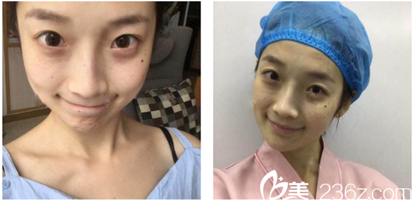 來深圳貝漾美天做雙眼皮前的照片 來深圳貝漾美天做雙眼皮前的照片