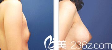 韓國UBA內視鏡隆胸手術真人<span style=