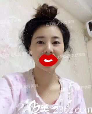 割雙眼皮術(shù)前照 割雙眼皮術(shù)前照