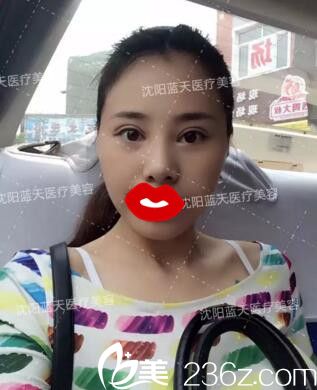 割雙眼皮術(shù)后拆線 割雙眼皮術(shù)后拆線