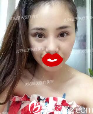 割雙眼皮術(shù)后第十天 割雙眼皮術(shù)后第十天