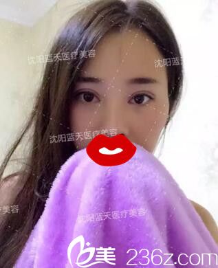 親身經(jīng)歷：分享沈陽(yáng)藍(lán)天于國(guó)艷給我做的全切雙眼皮術(shù)后半個(gè)月恢復(fù)效果圖
