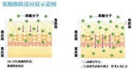 果酸嫩膚的方法 果酸嫩膚的方法