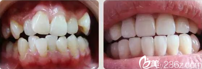 苗智許醫(yī)師口腔正畸案例 苗智許醫(yī)師口腔正畸案例