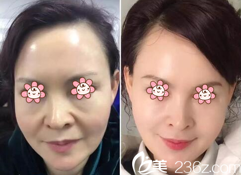 杜航航面部年輕化案例 杜航航面部年輕化案例