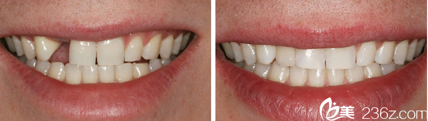 遇海波種植牙案例 遇海波種植牙案例