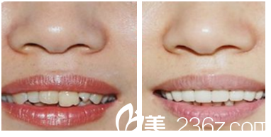 遇海波冷光美白牙齒案例 遇海波冷光美白牙齒案例