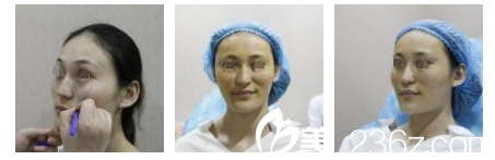 玻尿酸填充術(shù)前面部凹陷嚴(yán)重 玻尿酸填充術(shù)前面部凹陷嚴(yán)重