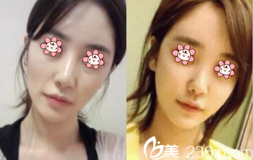 陳先鳳醫(yī)師面部脂肪填充案例 陳先鳳醫(yī)師面部脂肪填充案例