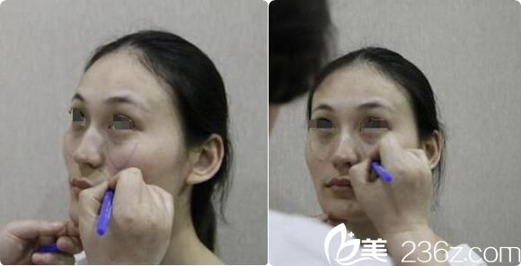 艾莉薇玻尿酸注射術(shù)前面診設(shè)計 艾莉薇玻尿酸注射術(shù)前面診設(shè)計