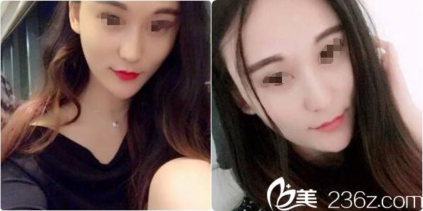 注射玻尿酸填充術(shù)后半個月恢復(fù) 注射玻尿酸填充術(shù)后半個月恢復(fù)