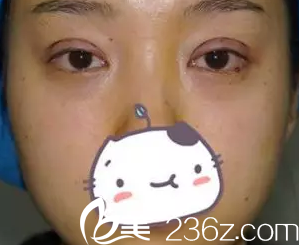 我在大同美神做全切雙眼皮術(shù)后第3天的照片