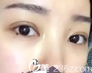 我在大同美神做切開雙眼皮7天拆線的照片