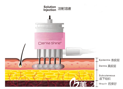 溶液注射層次圖 溶液注射層次圖