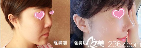 曹令假體隆鼻<span style=