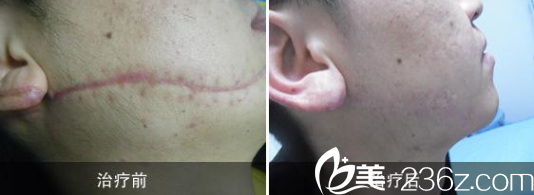 韋志遠(yuǎn)醫(yī)師疤痕修復(fù)案例