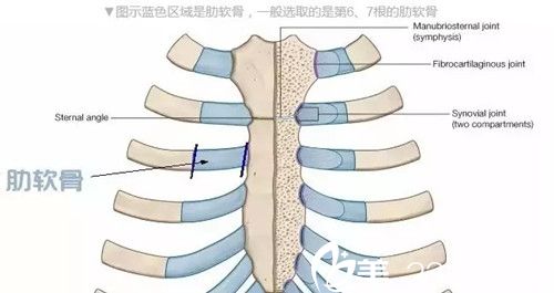 肋軟骨隆鼻 肋軟骨隆鼻