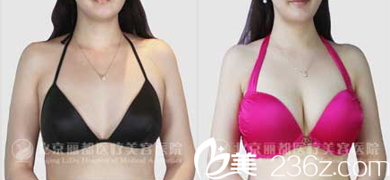 石冰自體脂肪豐胸案例 石冰自體脂肪豐胸案例