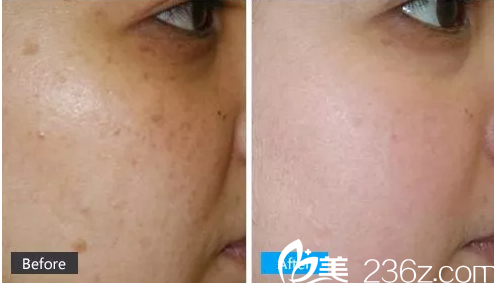 江子旭激光祛斑案例