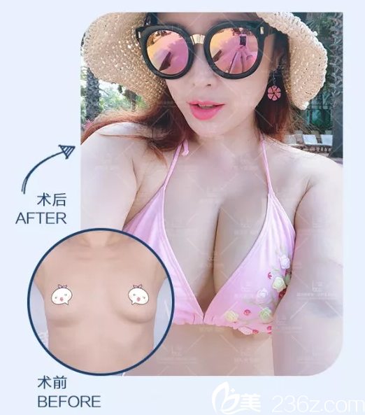 陳萬(wàn)芳自體脂肪豐胸案例