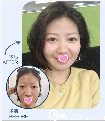 陳萬(wàn)芳自體脂肪面部填充案例