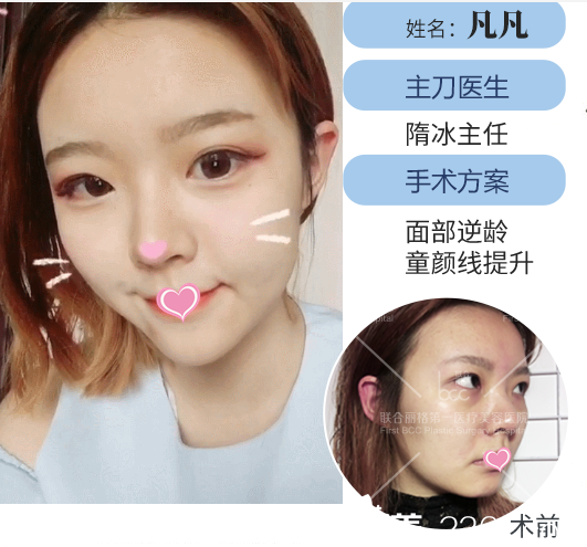 隋冰面部提升案例效果 隋冰面部提升案例效果