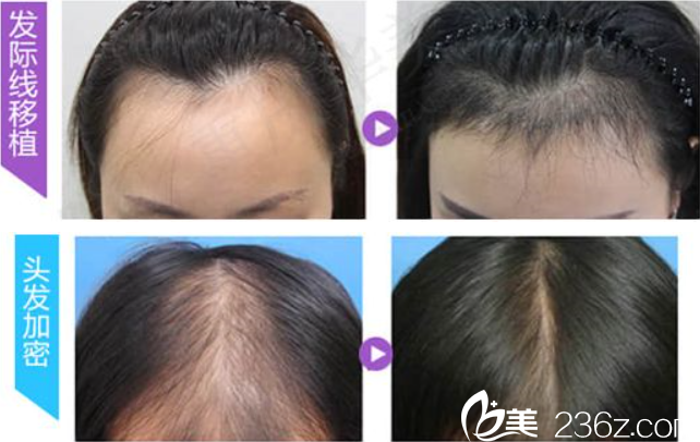 陳善友毛發(fā)移植案例