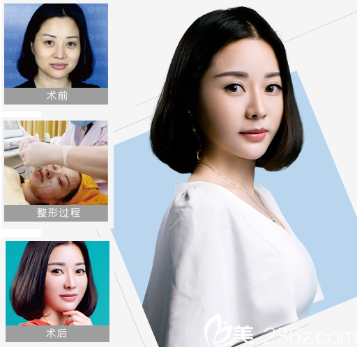 深圳非凡整形醫(yī)院熱拉提和拉皮手術(shù)案例圖