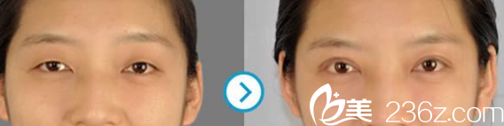 Seven Days整形外科醫(yī)院雙眼皮案例 Seven Days整形外科醫(yī)院雙眼皮案例