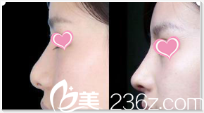 Seven Days整形外科醫(yī)院假體隆鼻案例 Seven Days整形外科醫(yī)院假體隆鼻案例