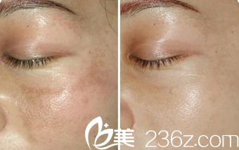 Seven Days整形外科醫(yī)院激光祛斑案例 Seven Days整形外科醫(yī)院激光祛斑案例