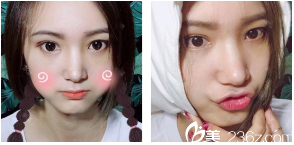 深圳港丹(美詩沁)祛眼袋術(shù)后兩個月圖片 深圳港丹(美詩沁)祛眼袋術(shù)后兩個月圖片