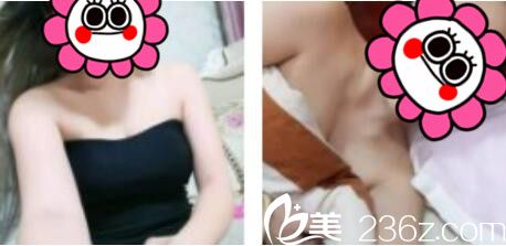 昆明韓辰醫(yī)療美容醫(yī)院胡喬假體隆胸真人案例術(shù)后十五天