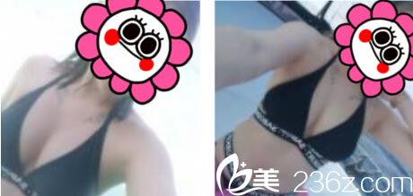 昆明韓辰醫(yī)療美容醫(yī)院胡喬假體隆胸真人案例術(shù)后一個(gè)月