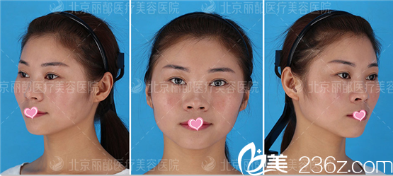 北京米蘭柏羽麗都自體脂肪面部填充案例術前照 北京米蘭柏羽麗都自體脂肪面部填充案例術前照