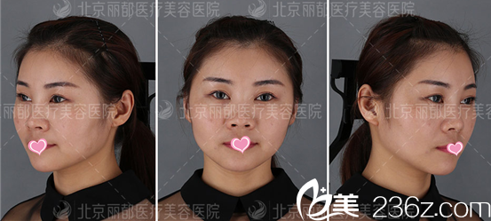 北京米蘭柏羽麗都石冰自體脂肪面部填充案例術后7天效果 北京米蘭柏羽麗都石冰自體脂肪面部填充案例術后7天效果