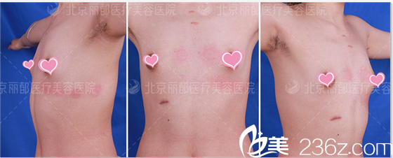 高超自體脂肪豐胸案例 高超自體脂肪豐胸案例