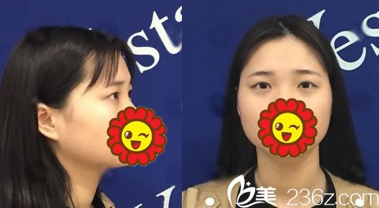 在寧波藝星做雙眼皮手術(shù)前 在寧波藝星做雙眼皮手術(shù)前