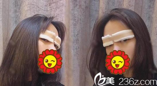 剛做完雙眼皮手術(shù)照片 剛做完雙眼皮手術(shù)照片