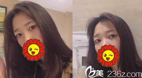 在寧波藝星做雙眼皮術(shù)后3天 在寧波藝星做雙眼皮術(shù)后3天