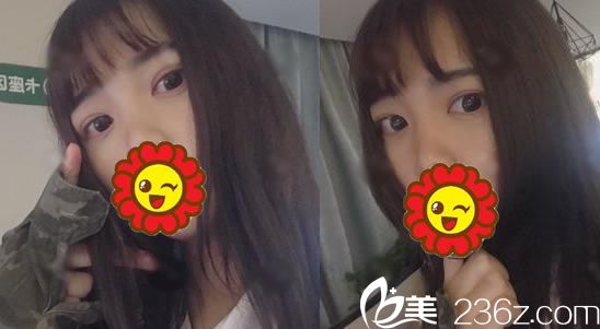 在藝星做全切雙眼皮術(shù)后30天 在藝星做全切雙眼皮術(shù)后30天