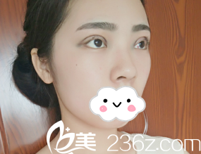 濰坊華美整形美容醫(yī)院任傳琦全切雙眼皮術(shù)后天的眼睛真的好腫 